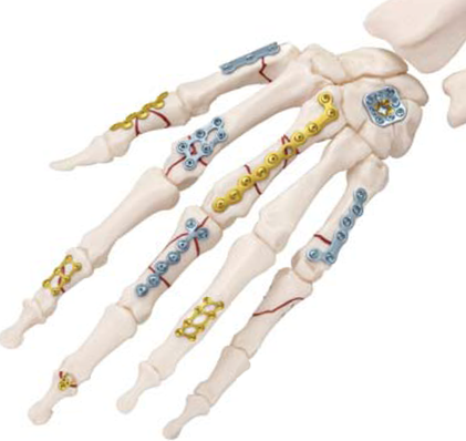 Finger Fracture Fixation  Central Coast Orthopedic Medical Group